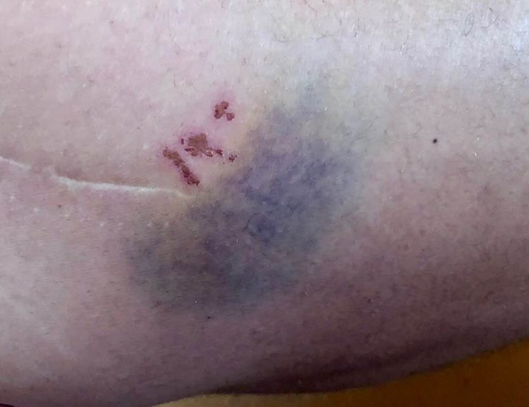 The scar: year’s ago hip surgery. The bruise: current blood thinners. The punctures: because I am such a klutz!